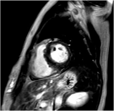 Genetic testing and human leukocyte antigen in patients with hypertrophic cardiomyopathy and connective tissue diseases